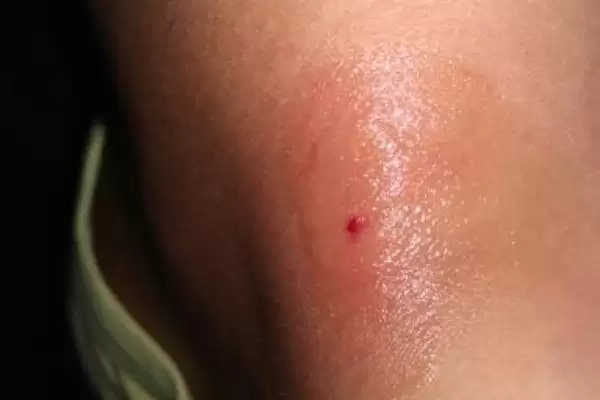 被蜜蜂蛰了怎么处理,要立刻远离蜂巢以免再次被蛰插图2 被蜜蜂蛰了怎么处理,要立刻远离蜂巢以免再次被蛰插图2