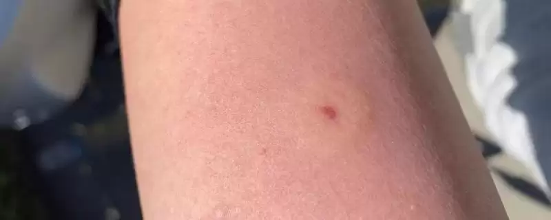 被人头蜂蛰了如何处理,应立即远离蜂巢、再用弱酸性溶液清洗伤口-会东网