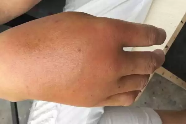 图片[2]-被马蜂蛰了怎么办，蜂毒过敏比蜂毒本身要危险-会东网