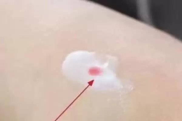 被蜜蜂蛰了怎么处理,要立刻远离蜂巢以免再次被蛰插图3 被蜜蜂蛰了怎么处理,要立刻远离蜂巢以免再次被蛰插图3