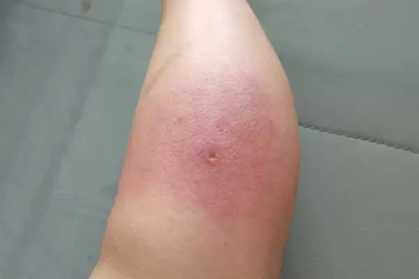 被蜜蜂蛰了怎么处理,要立刻远离蜂巢以免再次被蛰插图1 被蜜蜂蛰了怎么处理,要立刻远离蜂巢以免再次被蛰插图1