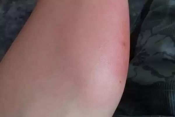 图片[4]-被马蜂蛰了多久毒发，几分钟后被蛰处便会出现红肿、瘙痒-会东网